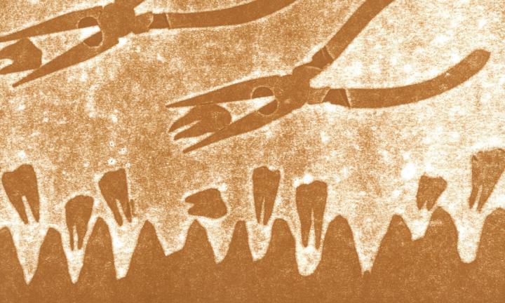 letterpress print of two pliers pulling out loose teeth from abstract gums 